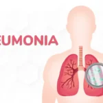 Penyakit Pneumonia